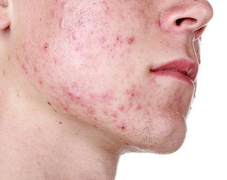 Things You're Doing that Aggravate Your Acne