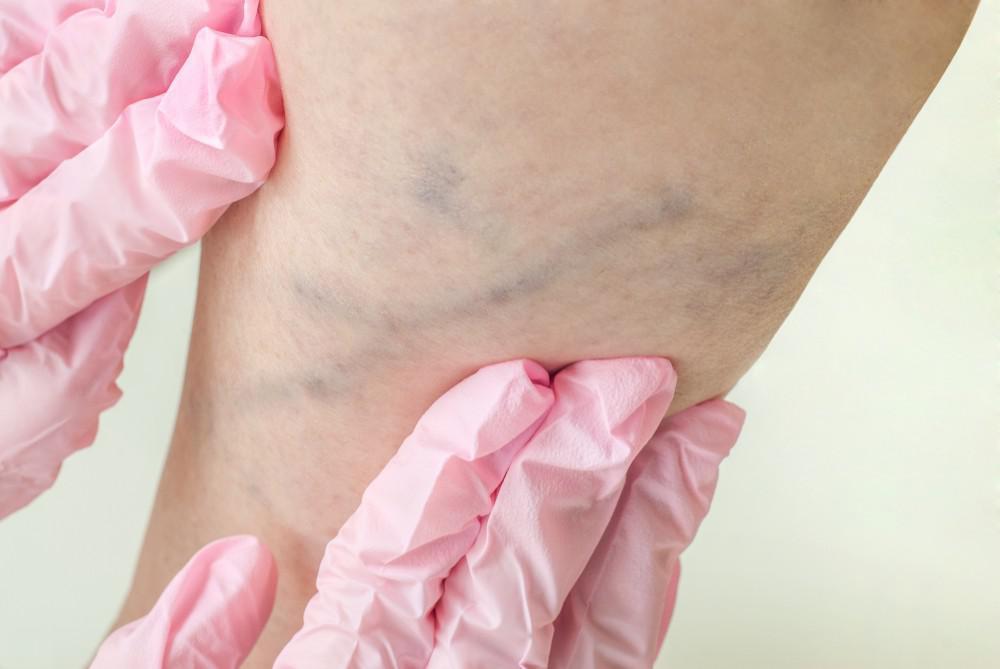 What to Do About Bothersome, Bulging Leg Veins